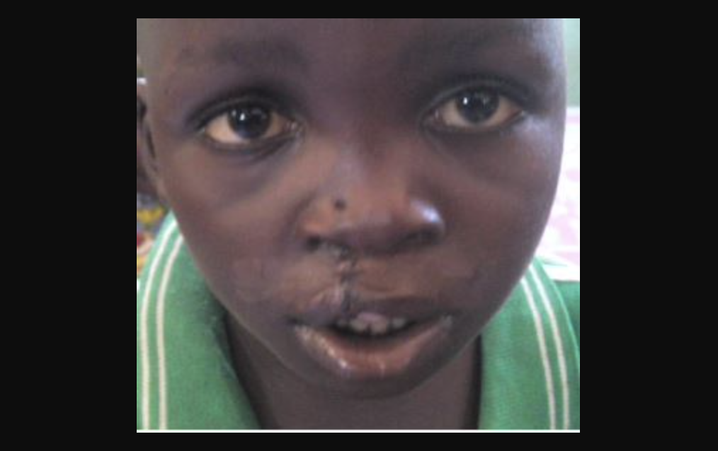 Ruanda - 2014 - Deutsche-Cleft-Kinderhilfe e.V. - Thierry