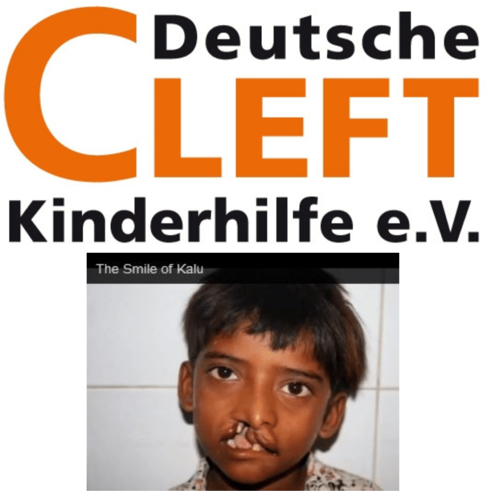 Indien-2013-Cleft-Spaltkinder/Kalu